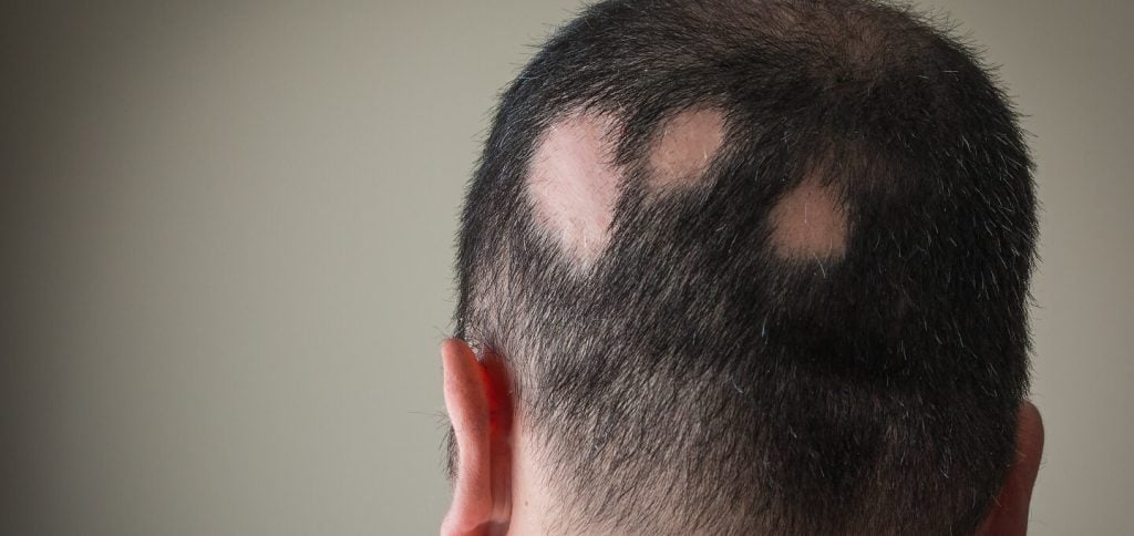 Who Is Not a Good Candidate for a Hair Transplant? Full Guide