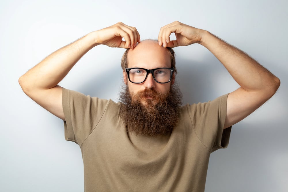 Where Do Hair Transplants Come From? Donor Area Explained 7 Where Do Hair Transplants Come From? Donor Area Explained