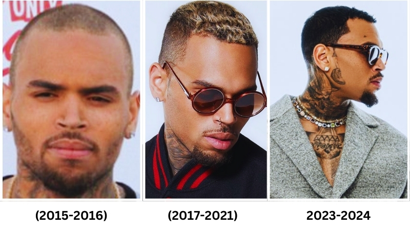 Where Did Chris Brown Get His Hair Transplant? Hairline Analysis