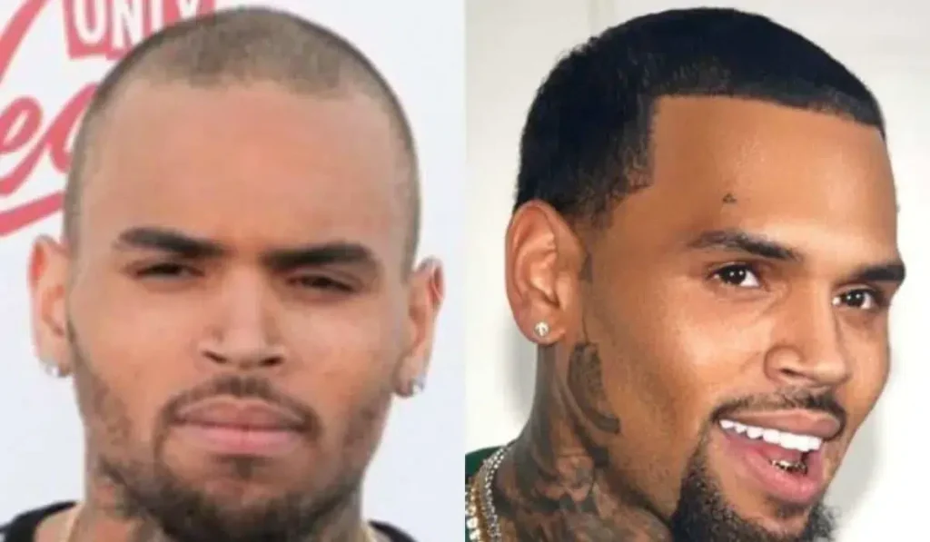 chris brown hair transplant