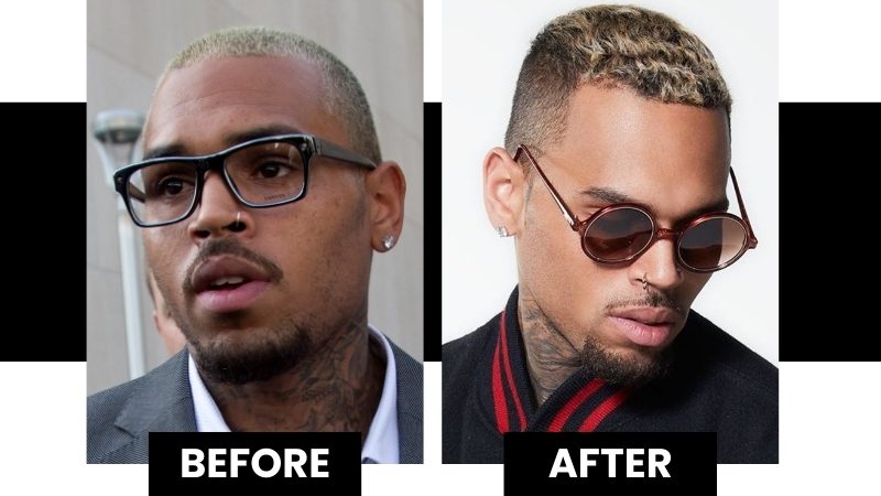 Where Did Chris Brown Get His Hair Transplant? Hairline Analysis