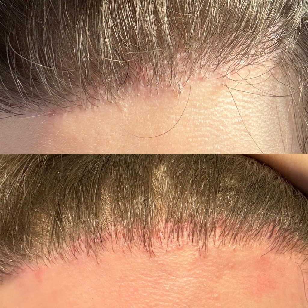 Cobblestoning Hair Transplant: Causes, Fixes & Prevention Guide