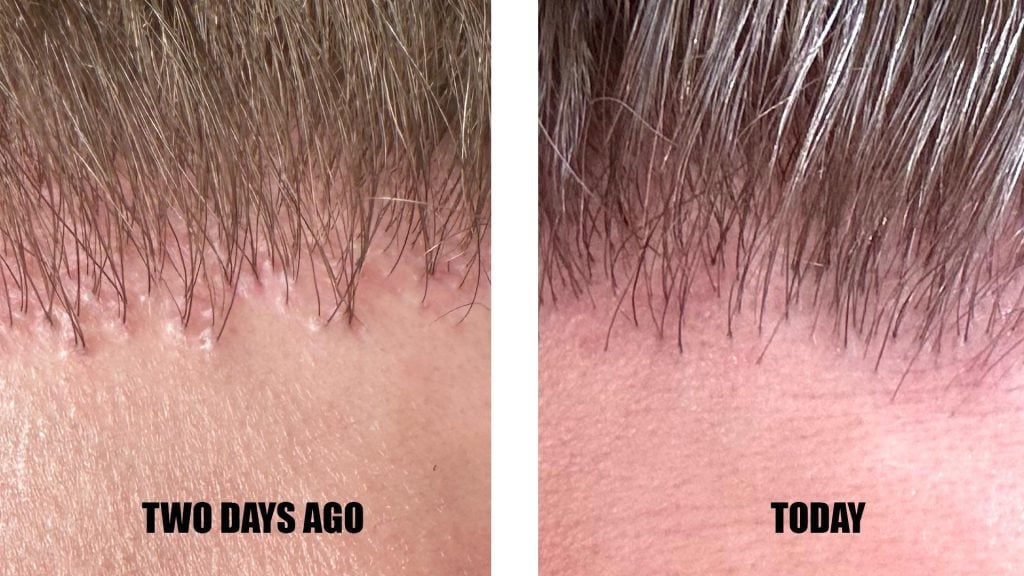 cobblestoning hair transplant