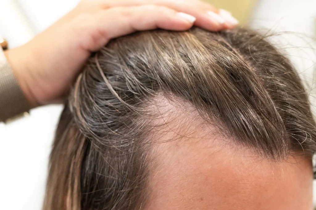 Does Creatine Cause Hair Loss? Latest Research & Expert Answers 4 Does Creatine Cause Hair Loss? Latest Research & Expert Answers