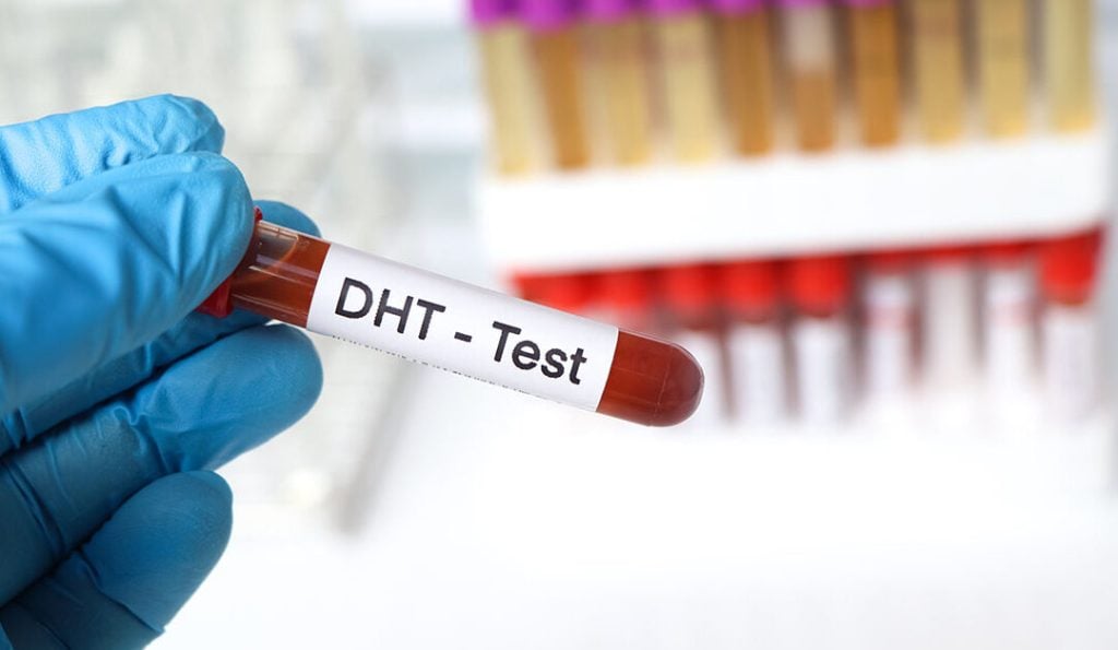 How to Stop Receding Hairline: Treatments & What Works 2 How to Stop Receding Hairline: Treatments & What Works