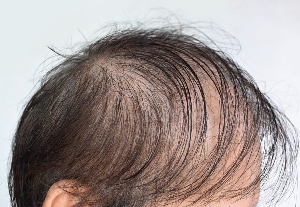 Who Is Not a Good Candidate for a Hair Transplant? Full Guide