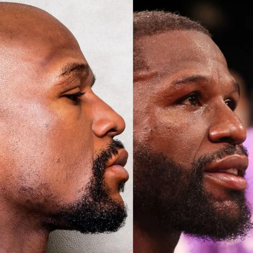Floyd Mayweather Hair Transplant: Before & After + Beard Analysis