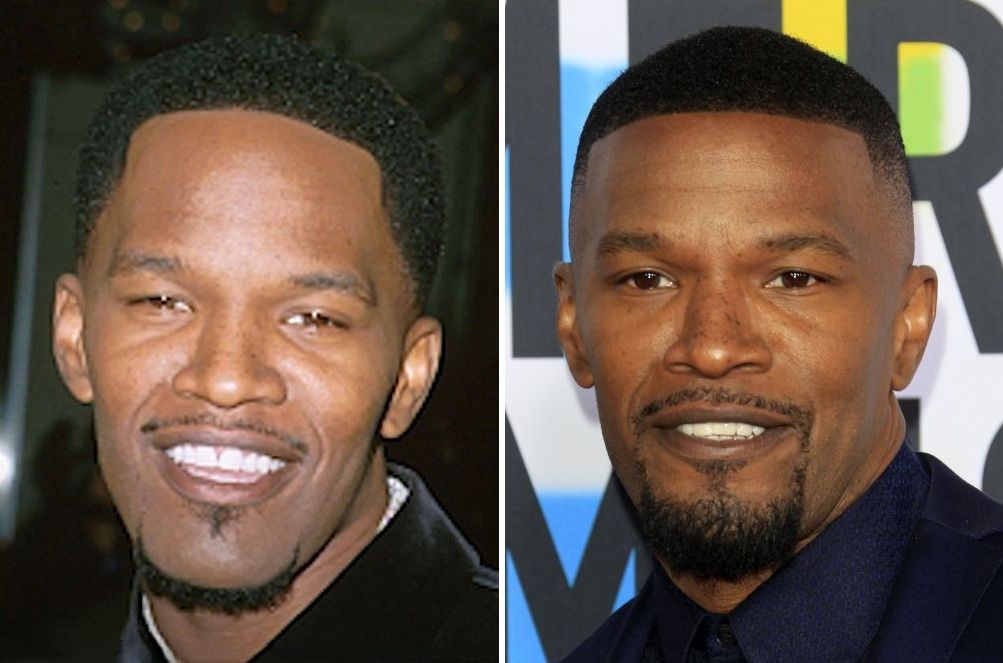 Jamie Foxx Hair Transplant: Before & After Hairline Analysis 1 jamie foxx hair transplant