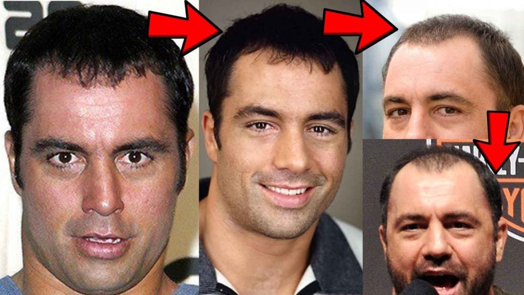 Joe Rogan Hair Transplant: FUT Scar, Story & Hair Loss Explained