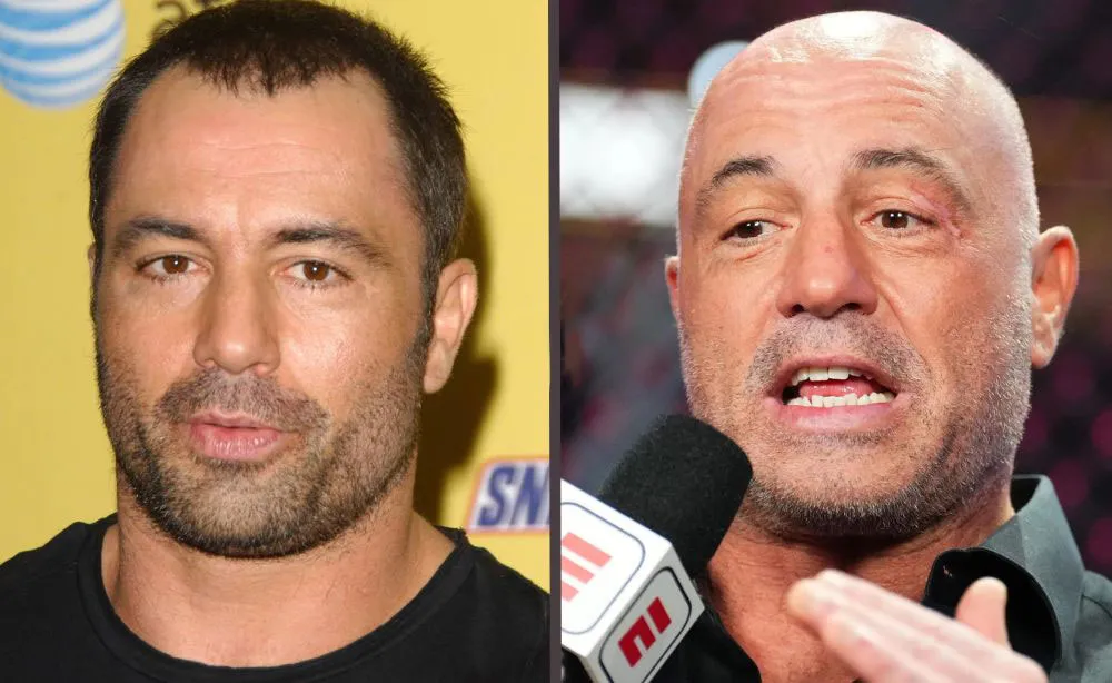 joe rogan hair transplant