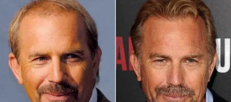 kevin-costner-hair-transplant-review
