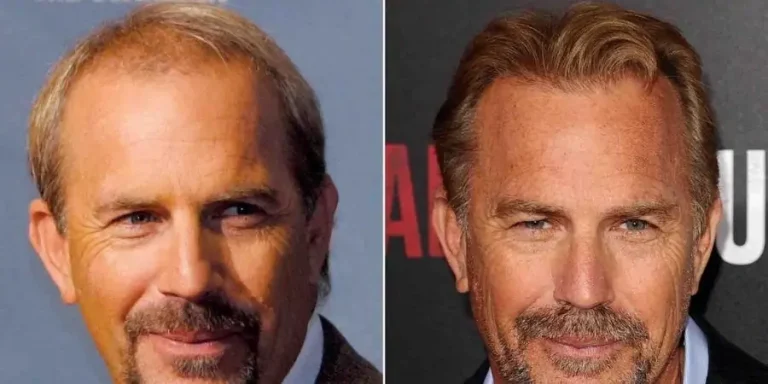 Kevin Costner Hair Transplant: Hairline Analysis & Hair Loss Speculation