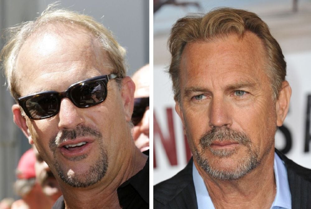 Kevin Costner Hair Transplant: Hairline Analysis & Hair Loss Speculation 1 kevin costner hair transplant