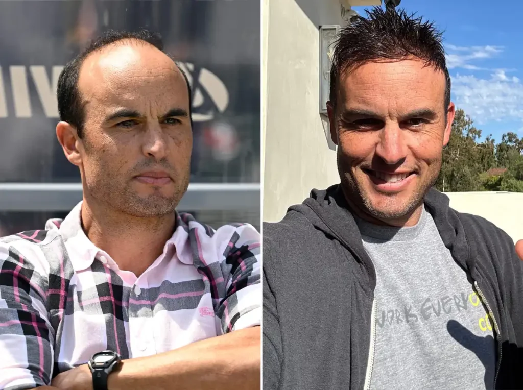 Landon Donovan Hair Transplant: Before & After Hairline Analysis 3 landon donovan hair transplant