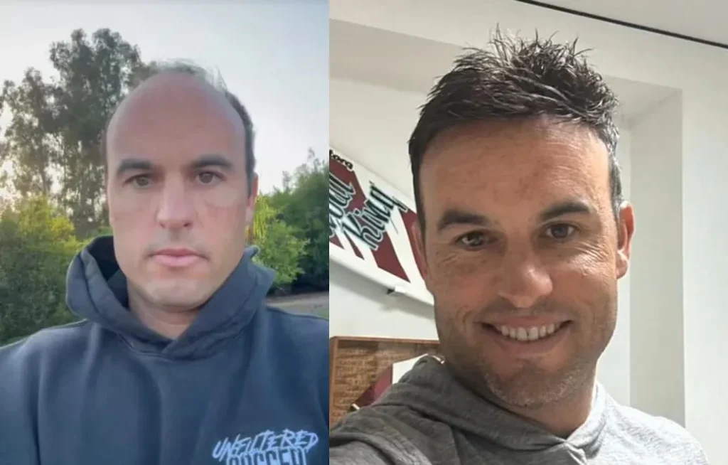 Landon Donovan Hair Transplant: Before & After Hairline Analysis 1 Landon Donovan Hair Transplant: Before & After Hairline Analysis