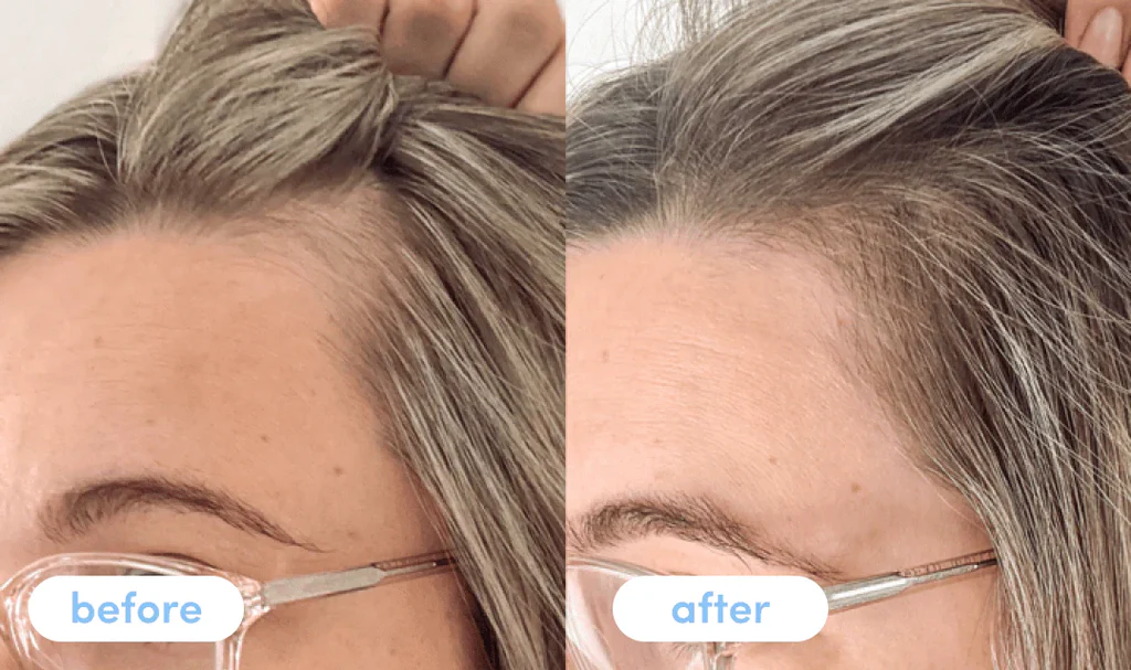 Postpartum Hair Loss: Causes, Timeline & How to Stop Shedding