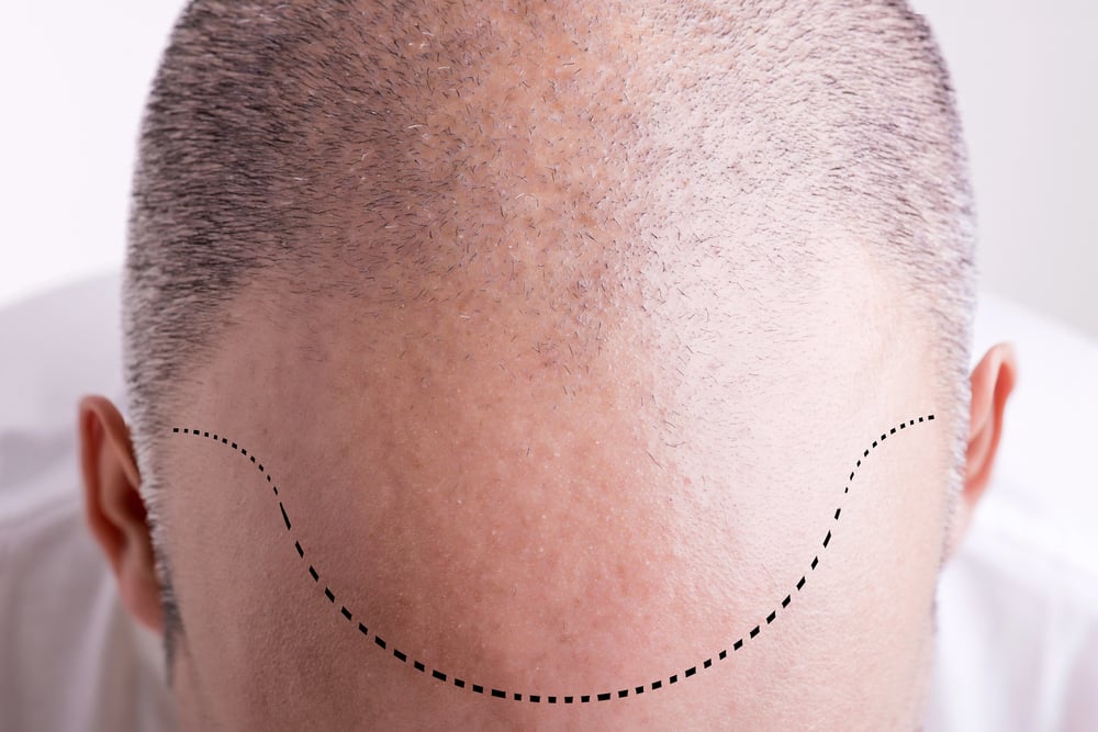 How to Stop Receding Hairline: Treatments & What Works 1 receding hairline