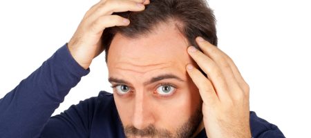 receding-hairline-men