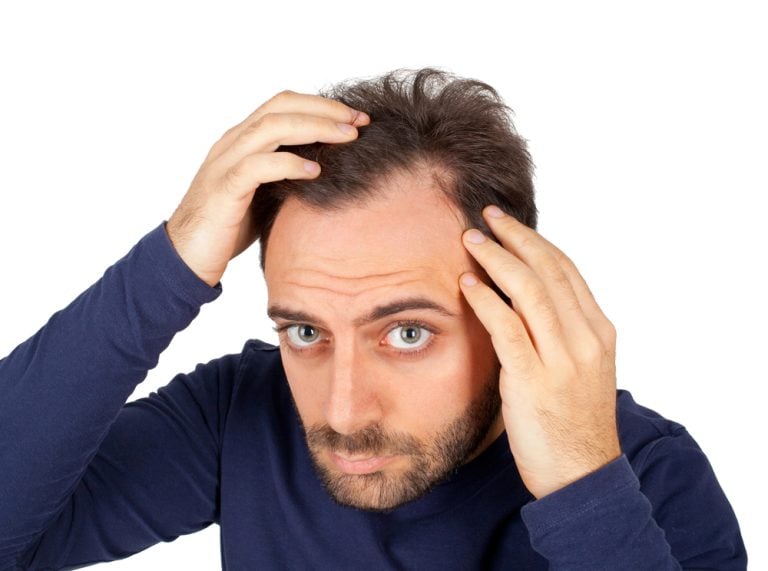 How to Stop Receding Hairline: Treatments & What Works