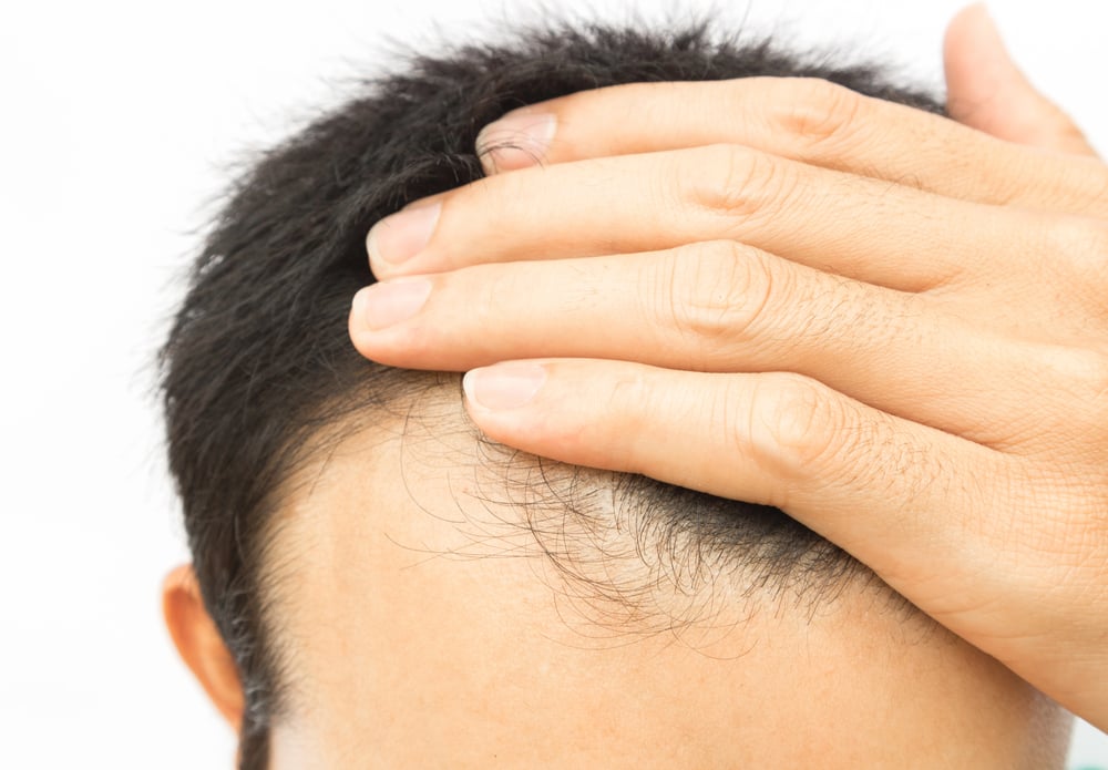 How to Stop Receding Hairline: Treatments & What Works 3 How to Stop Receding Hairline: Treatments & What Works