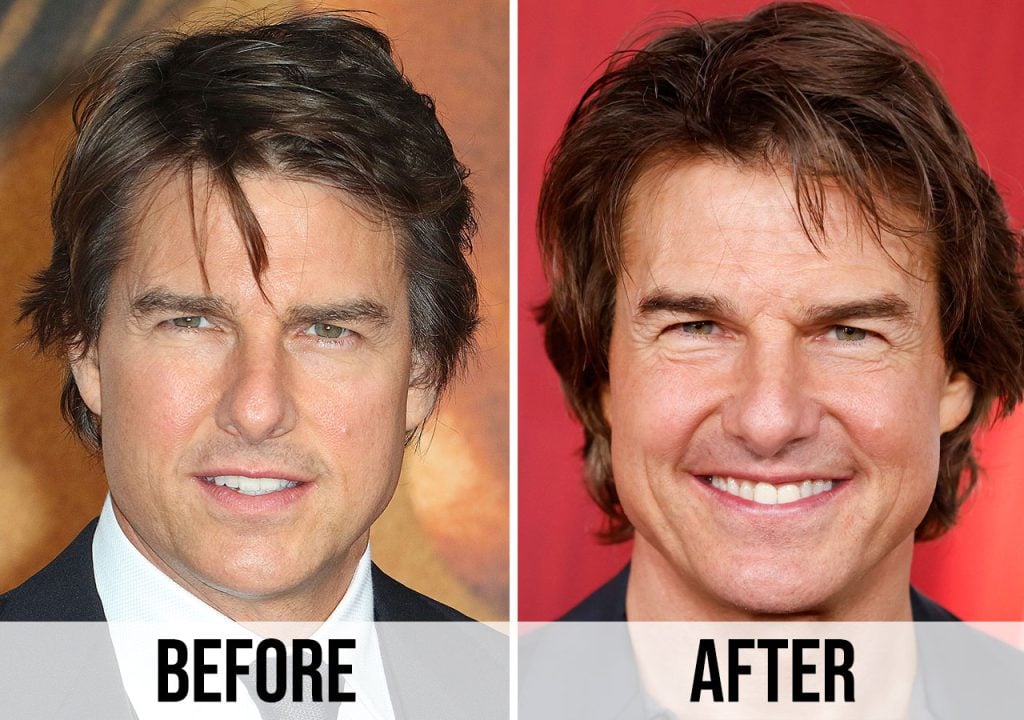 Tom Cruise Hair Transplant: Hairline Analysis & Before After 1 tom cruise hair transplant