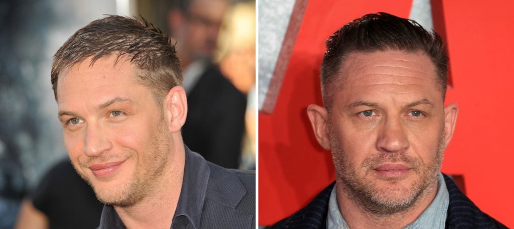 Tom Hardy Hair Transplant: Hairline Analysis, Before & After 1 tom hardy hair transplant