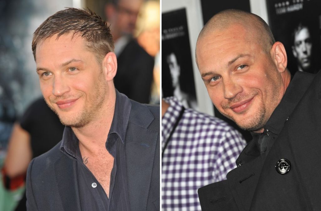 Tom Hardy Hair Transplant: Hairline Analysis, Before & After 2 Tom Hardy Hair Transplant: Hairline Analysis, Before & After
