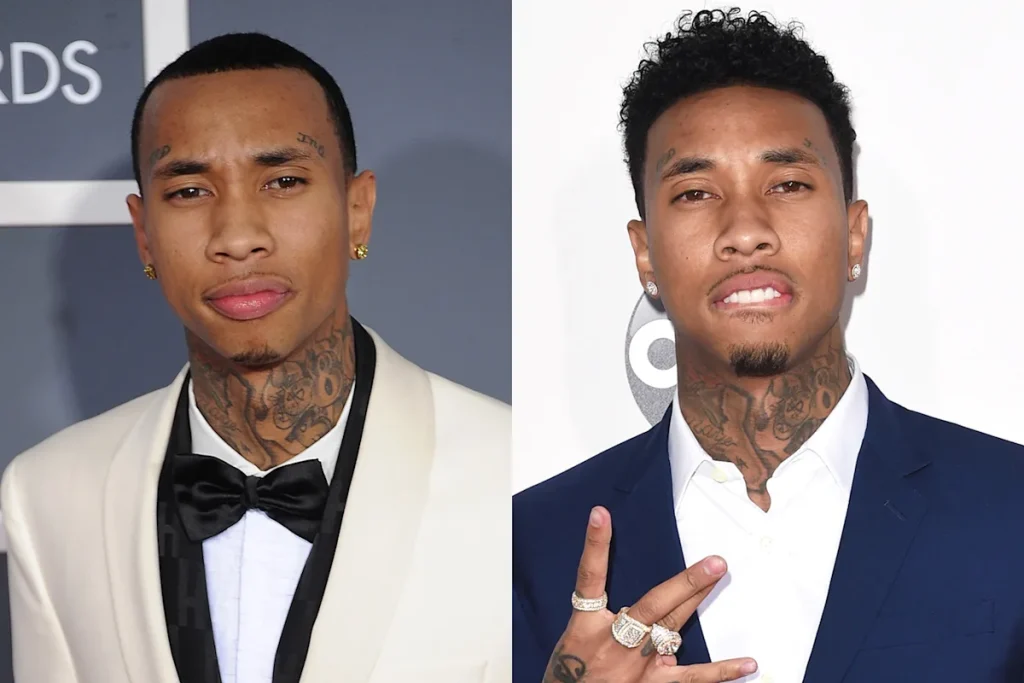 tyga hair transplant