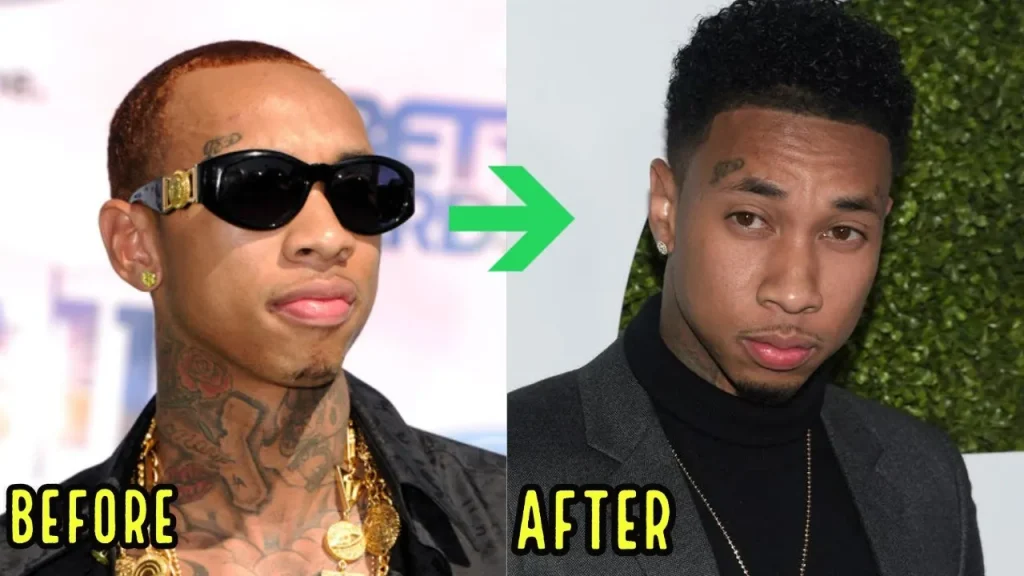 Tyga Hair Transplant: Before & After, Cost, Grafts & Results
