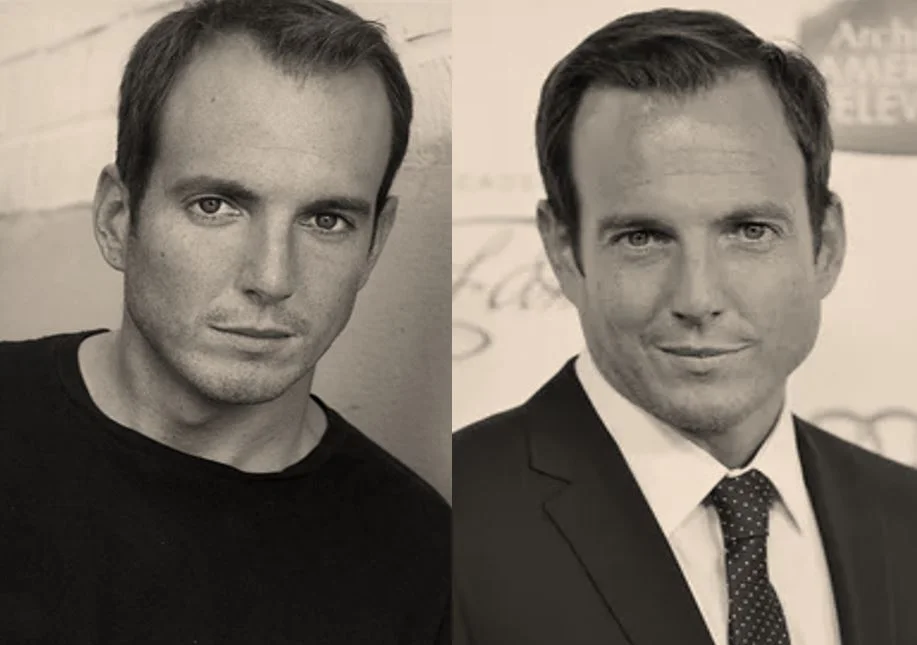 Will Arnett Hair Transplant: Did He Really Fix His Hairline? 1 Will Arnett Hair Transplant: Did He Really Fix His Hairline?