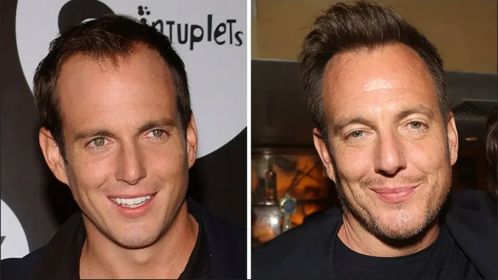 Will Arnett Hair Transplant: Did He Really Fix His Hairline? 2 will arnett hair transplant