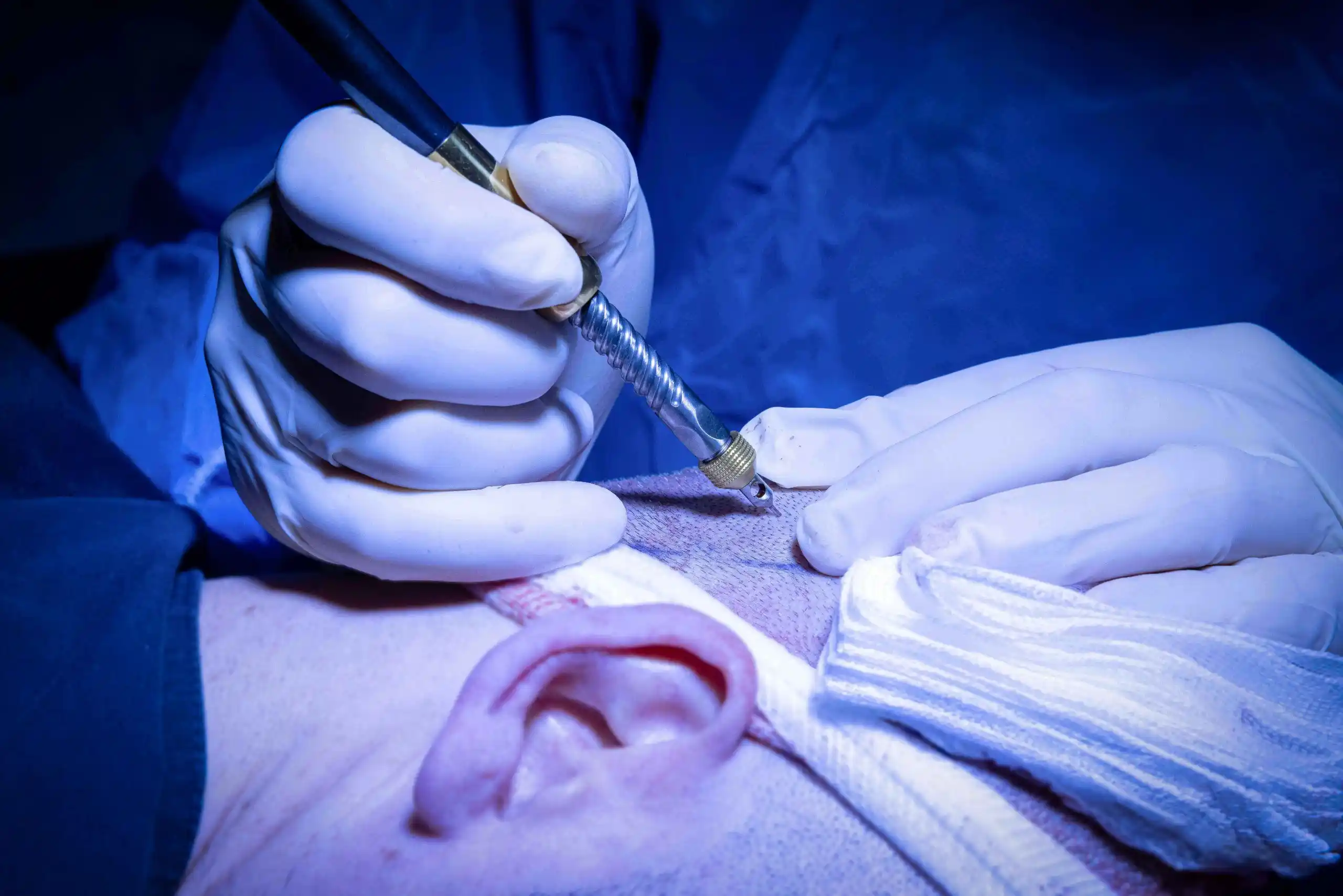manuel punch hair transplant