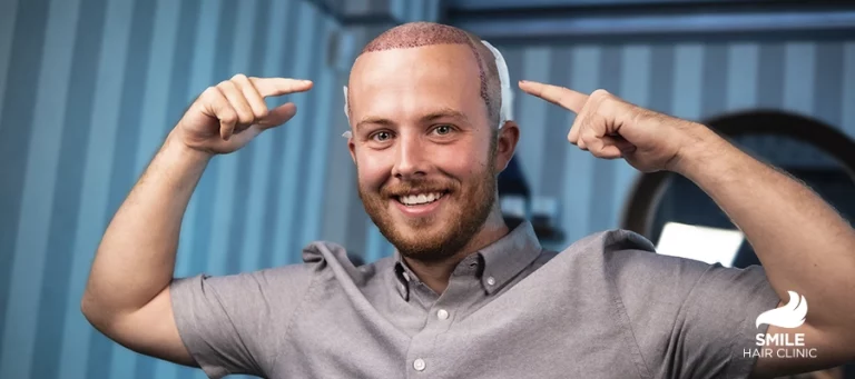 5 Things to Consider Before a Hair Transplant