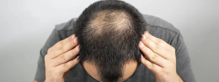 Depression and Hair Loss