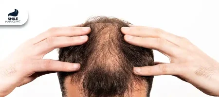 Early Age Hair Loss