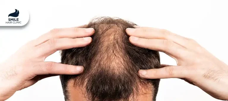 Early Age Hair Loss