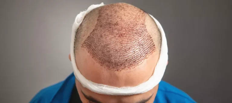 How do I know how many grafts are needed for a hair transplant?