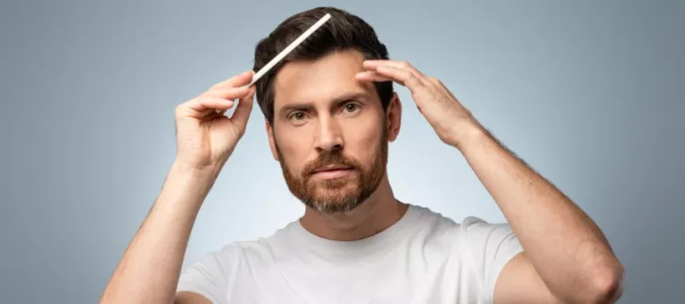 Things to Consider Before a 5000 Graft Hair Transplant