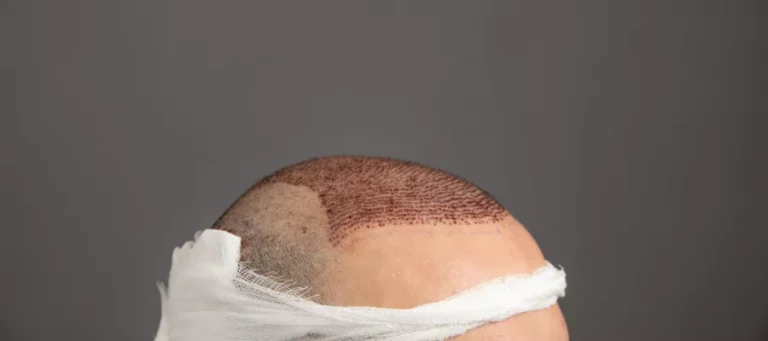 When does hair density increase after a hair transplant?