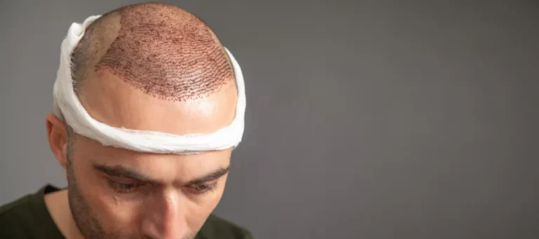 Why is patience important after a hair transplant?