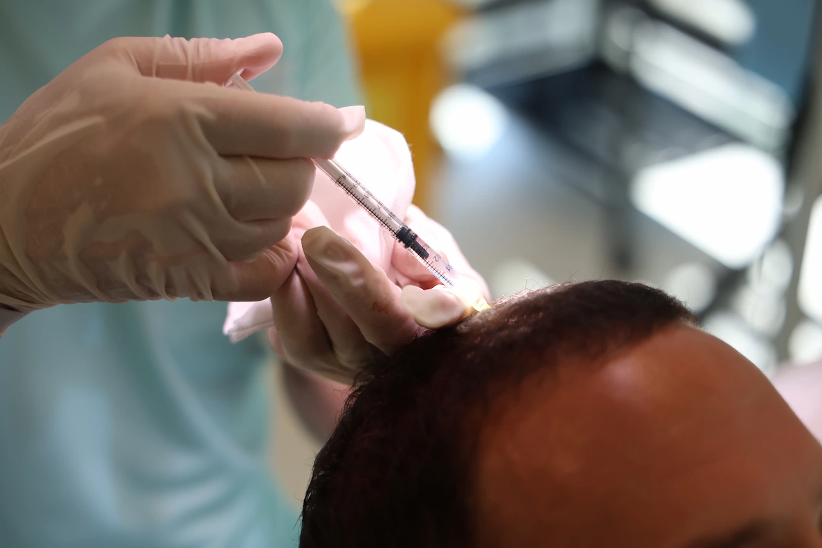 Mike Majlak Back to Smile Hair Clinic, This Time for PRP and Exosome Therapy 1 What PRP and Exosome Therapy Actually Are