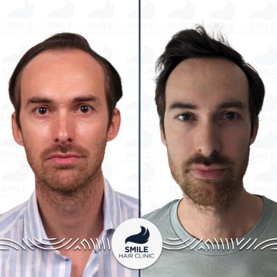 Antoine L 2700 Grafts Sapphire FUE Before After(2)