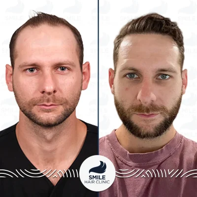 Brian S 4200 Grafts Sapphire FUE Before After(3)_2026
