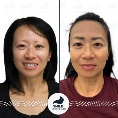 Cindy L 450 Grafts Sapphire FUE Eyebrow Transplant Before After(3)_2026