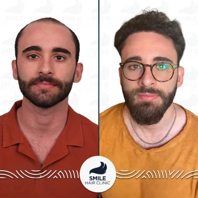 Cristian V 4650 Grafts Sapphire FUE Before After(3)_2026