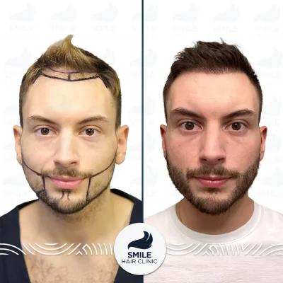 Harrison D 4000 Grafts Sapphire FUE Beard Transplant Before After(2)_2026