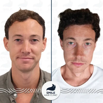 Harvey A 4000 Grafts Sapphire FUE Before After_2026