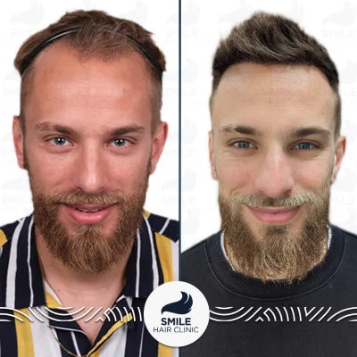 James B 2800 Grafts Sapphire FUE Before After(3)_2026