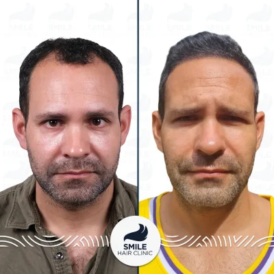 JamesN4100GraftsSapphireFUEHairTransplant_2026