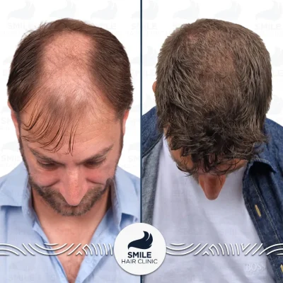 Joe H 4800 Grafts Sapphire FUE Before After_2026